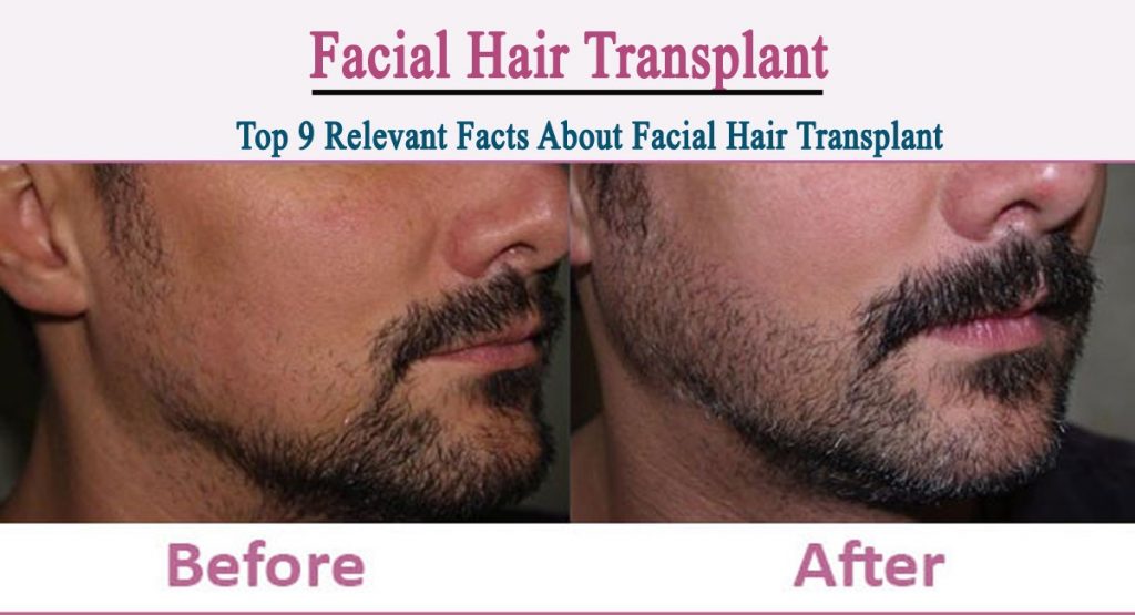 Facial hair transplant