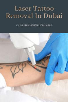 Laser tattoo removal in Dubai
