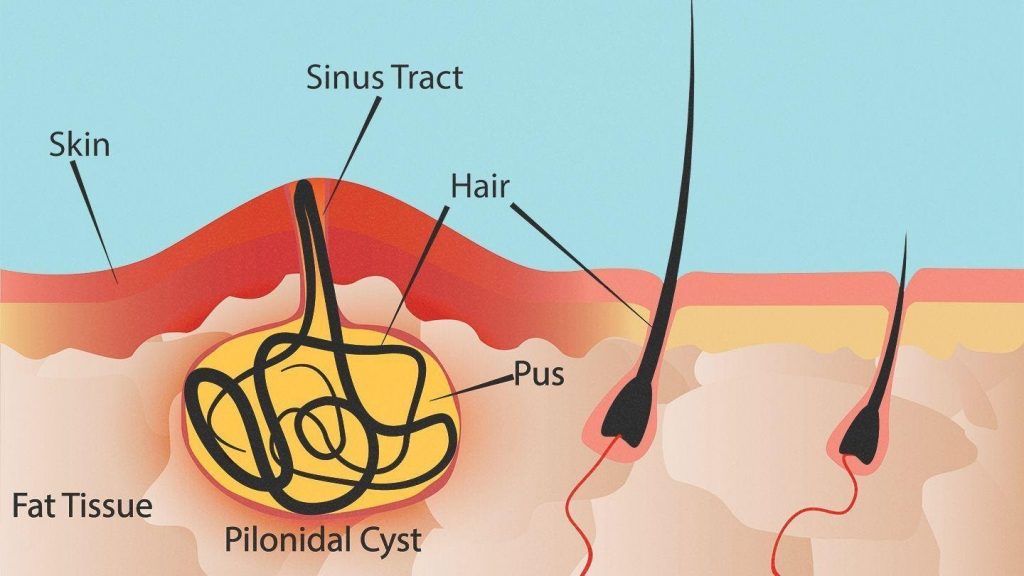 piles and pilonidal sinus