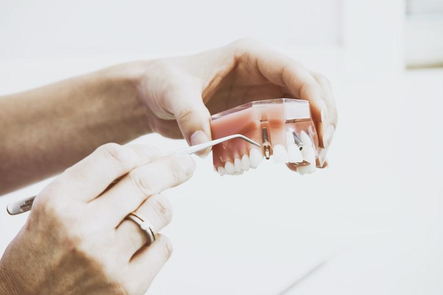 Dentures vs. Implants: Pros and Cons for Seniors
