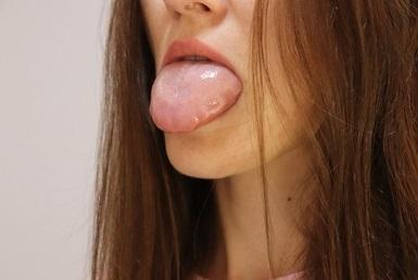 swollen and red tongue