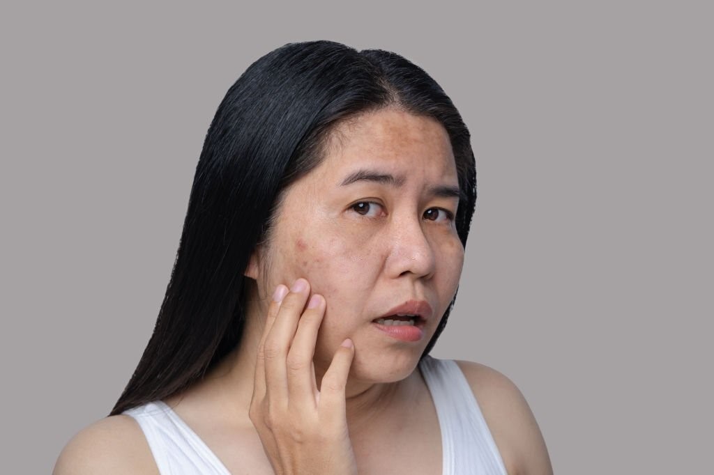 holistic acne treatment for hormonal imbalance