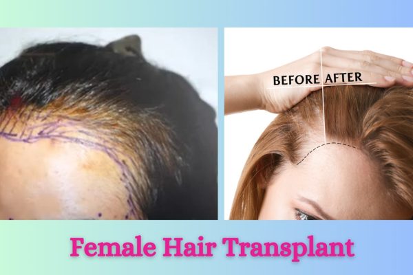 frmale hair transplant