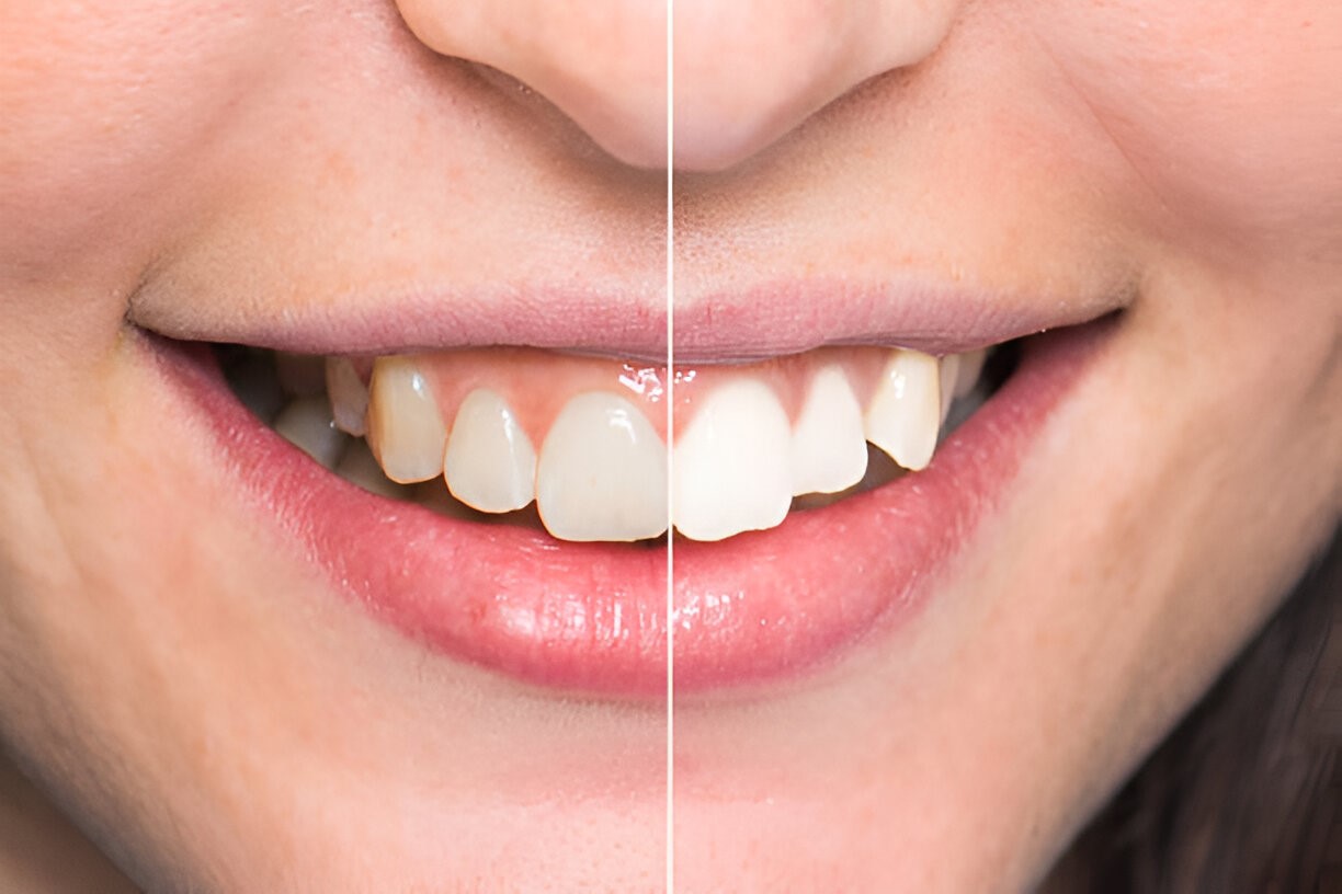 Can Teeth Whitening Be Done if I Have Sensitive Teeth in Aberdeen?