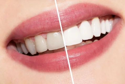 Top Benefits of Choosing Professional Teeth Whitening in Bastrop