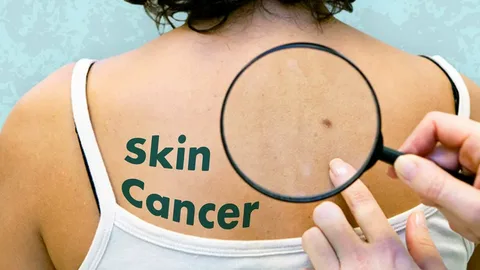 What is SRT Skin Cancer Treatment? Explained
